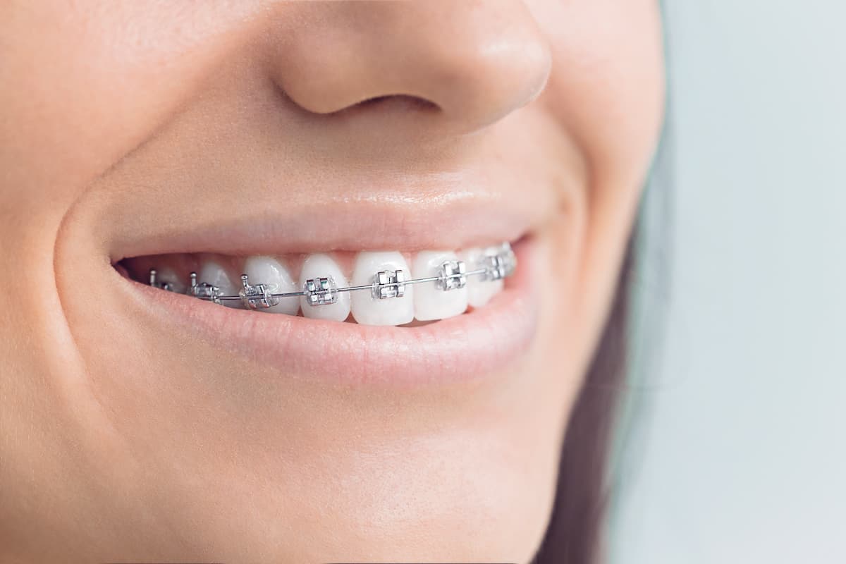 Brackets métalliques utilisés en orthodontie, montrant un appareil d'alignement dentaire traditionnel pour corriger les problèmes d'alignement des dents.